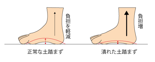 シンスプリントとは？